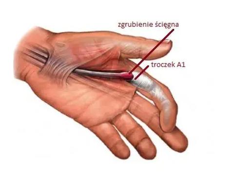Podcięcie żył
